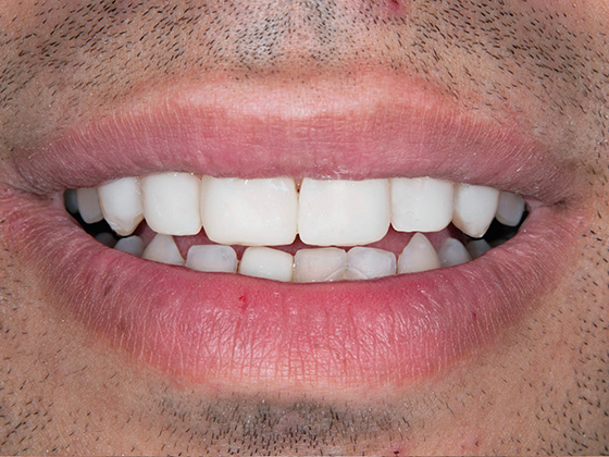 ÄSTHETISCHE ZAHNHEILKUNDE (VENEERS) Nach