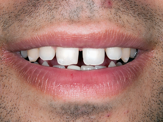 ÄSTHETISCHE ZAHNHEILKUNDE (VENEERS) Vor